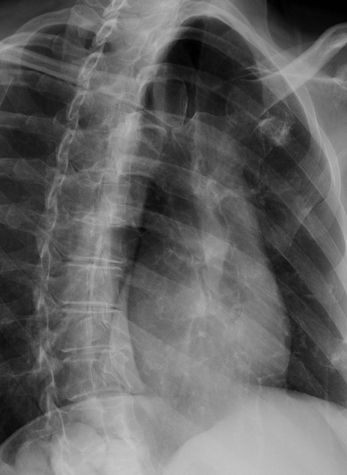 Sternum Lateral View Radiology Reference Article Radi